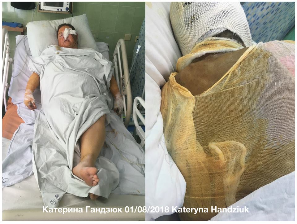 Появился фоторобот мужчины, облившего кислотой херсонскую активистку Гандзюк